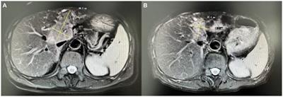 Case report: Paraneoplastic lower motor neuronopathy associated with a malignant liver tumor